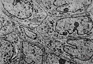 F,1y. | plexus papilloma F,1y. | plexus papilloma